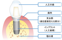 インプラント治療が、ブリッジと入れ歯のデメリットを解消します。